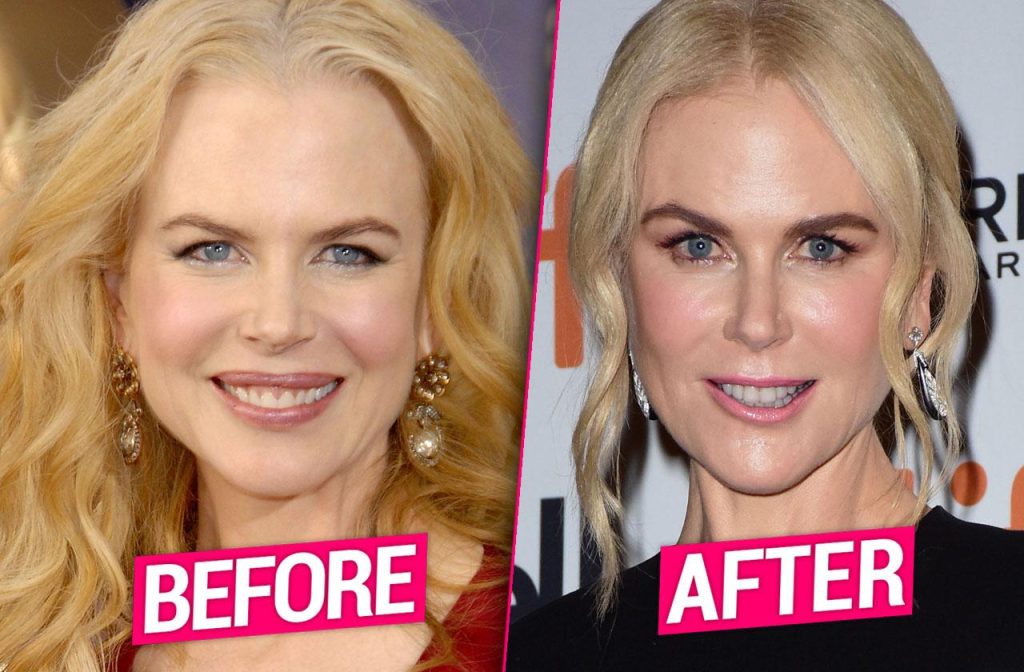 Nicole Kidman Plastic Surgery Before and After Plastic SurgerYes